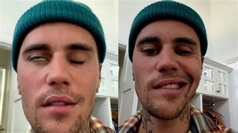 doença de justin bieber.